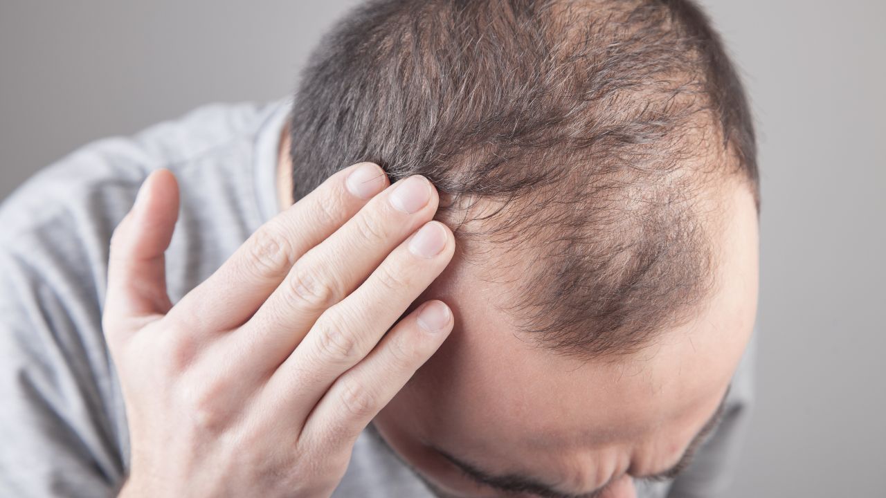 how long after stopping finasteride will hair fall out