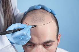 What To Expect During A Hair Transplant Consultation