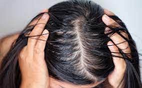 Best Hair Solutions For Oily Scalp