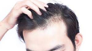 The Role Of Stress In Hair Loss
