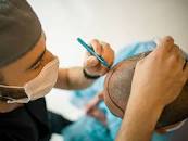 Understanding The Whole Hair Transplant Procedure