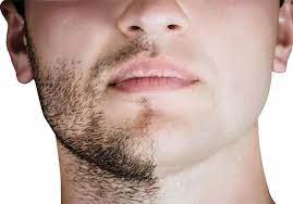 Facial Hair Transplant Near Me: A Complete Manual for Reestablishing Your Facial Hair and Mustache