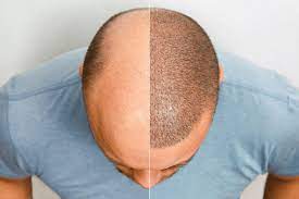 Hair Replacement Surgery Cost: Affordable Options for Restoring Your Hair