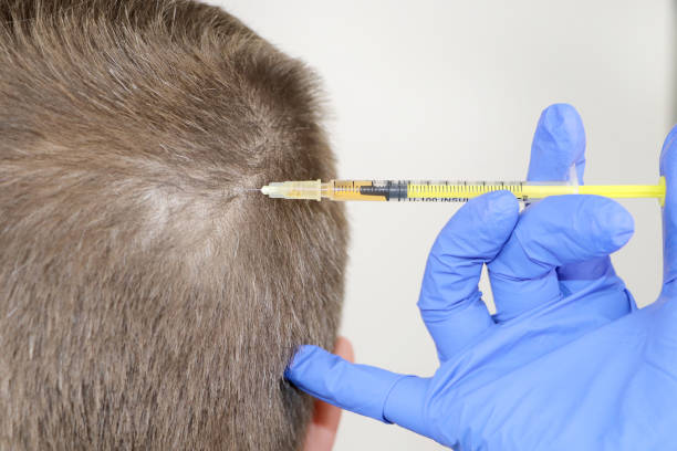 Reddit Hair Transplant Cost: Unveiling the Real Price of Restoring Your Hair