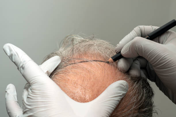 Navdeep Hair Transplant: Successful Hair Restoration