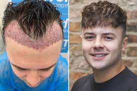 Hair Plant Price Breakdown: How Much Does a Hair Transplant Really Cost