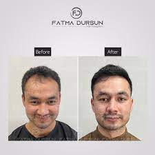Transform Your Look with Fatma Dursun Hair Transplant Services: Stat