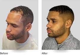 Transform Your Look with Sut Hair Transplant: A Cutting-Edge Solution for Hair Loss