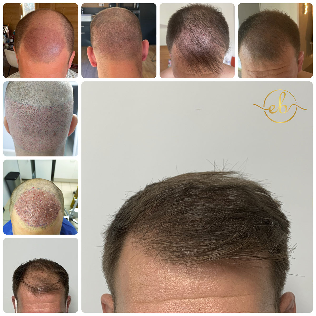 Ziering Medical: The Starting Point for Hair Restoration and Its Affordability