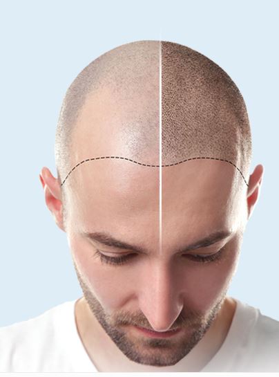 hue hair transplant