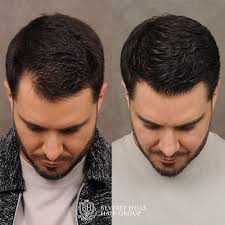 Transform Your Look: Experience Unmatched Results at the Nearest Hair Transplant Center