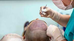 FUE Hair Transplant: Redditors Reveal Their Success Stories and Statistics