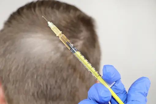 Bernstein Hair Transplant: A Revolutionary Solution for Hair Loss